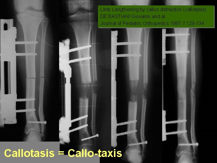 Limb Lengthening by callus distraction (callotasis) DE BASTIANI Giovanni and al. Journal of Pediatric