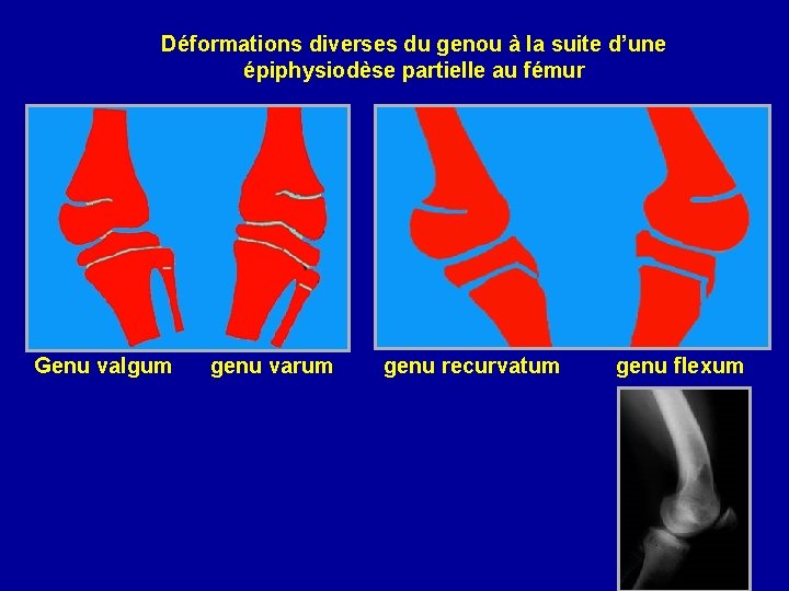 Déformations diverses du genou à la suite d’une épiphysiodèse partielle au fémur Genu valgum