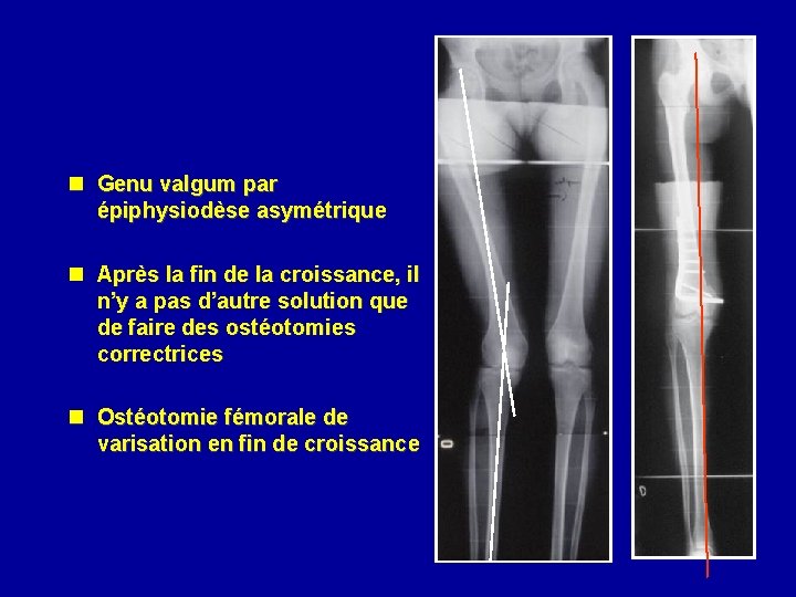 n Genu valgum par épiphysiodèse asymétrique n Après la fin de la croissance, il