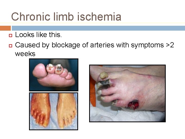Chronic limb ischemia Looks like this. Caused by blockage of arteries with symptoms >2 Chronic limb ischemia Looks like this. Caused by blockage of arteries with symptoms >2
