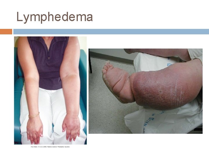 Lymphedema Lymphedema