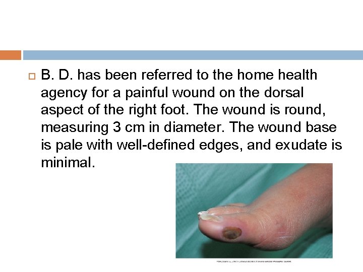 B. D. has been referred to the home health agency for a painful B. D. has been referred to the home health agency for a painful