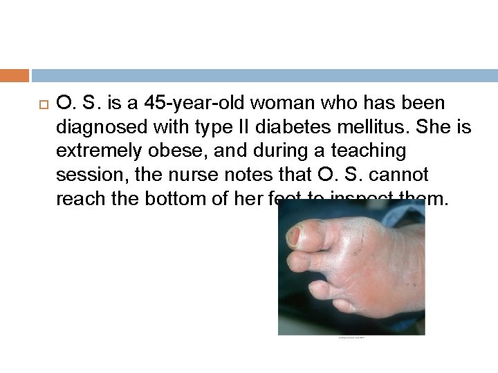 O. S. is a 45 -year-old woman who has been diagnosed with type O. S. is a 45 -year-old woman who has been diagnosed with type