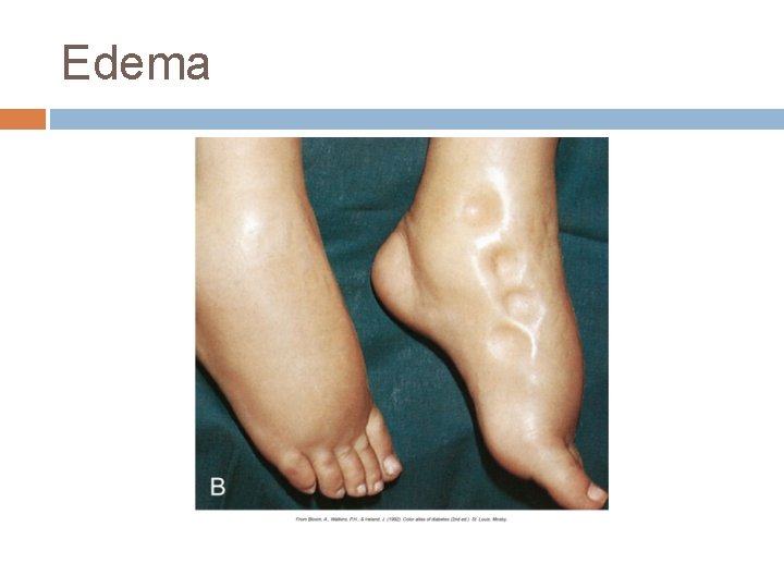 Edema Edema