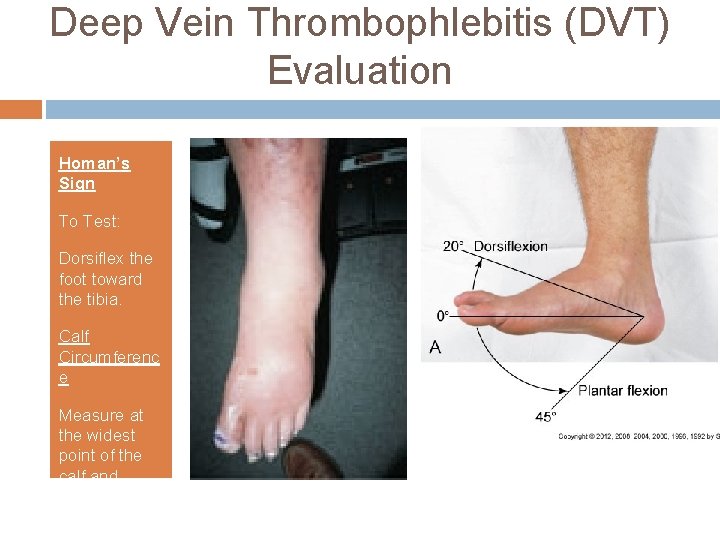 Deep Vein Thrombophlebitis (DVT) Evaluation Homan’s Sign To Test: Dorsiflex the foot toward the Deep Vein Thrombophlebitis (DVT) Evaluation Homan’s Sign To Test: Dorsiflex the foot toward the