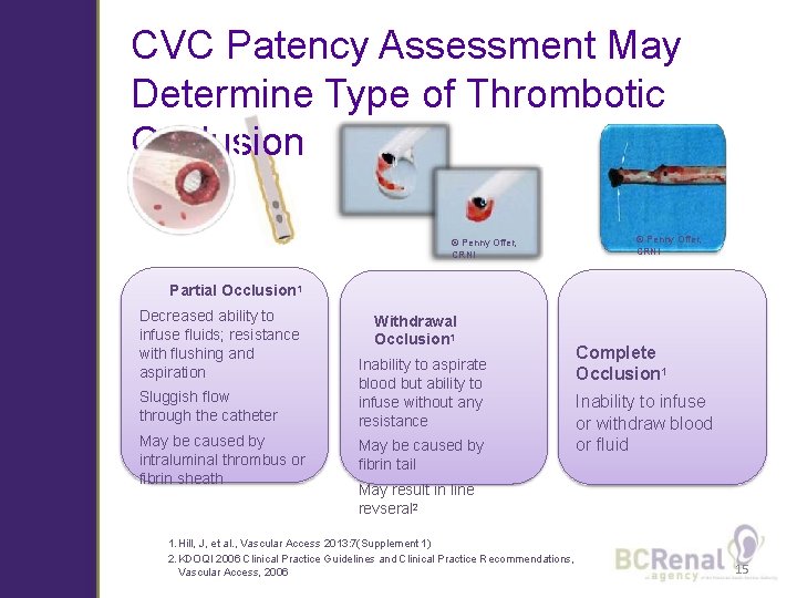 CVC Patency Assessment May Determine Type of Thrombotic Occlusion © Penny Offer, CRNI Partial