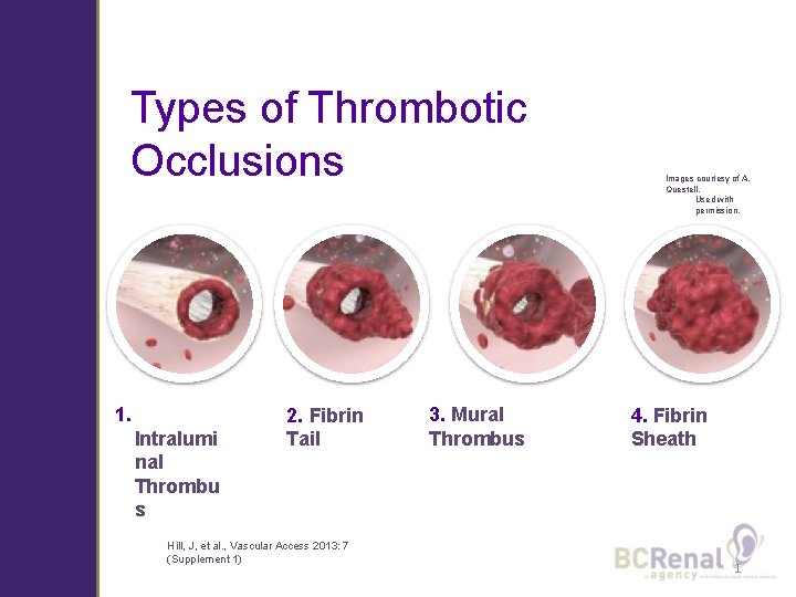 Types of Thrombotic Occlusions 1. Intralumi nal Thrombu s 2. Fibrin Tail Hill, J,