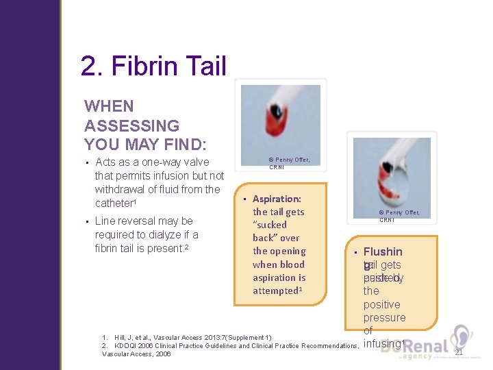 2. Fibrin Tail WHEN ASSESSING YOU MAY FIND: • • Acts as a one-way
