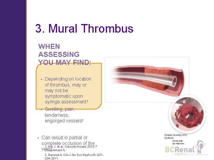 3. Mural Thrombus WHEN ASSESSING YOU MAY FIND: • • Depending on location of