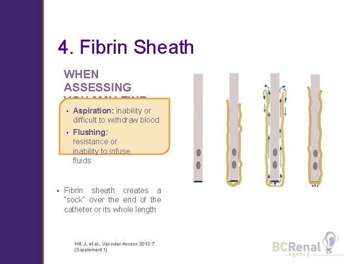 4. Fibrin Sheath WHEN ASSESSING YOU MAY FIND: • • Aspiration: inability or difficult