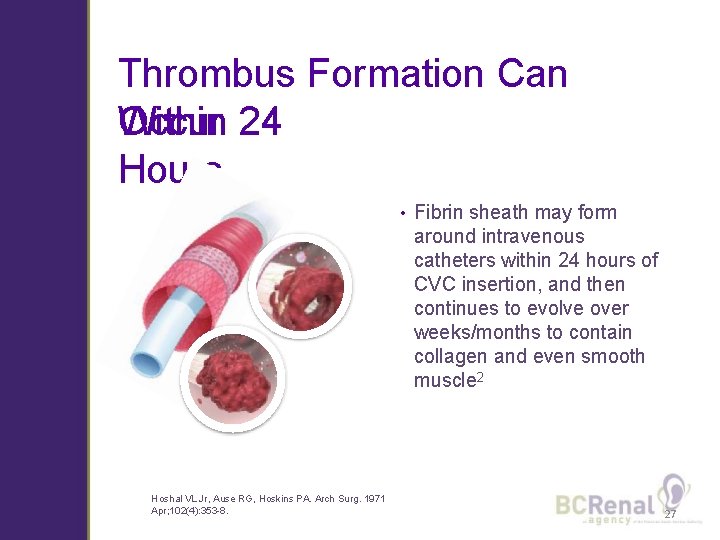 Thrombus Formation Can Within 24 Occur Hours • Hoshal VL Jr, Ause RG, Hoskins