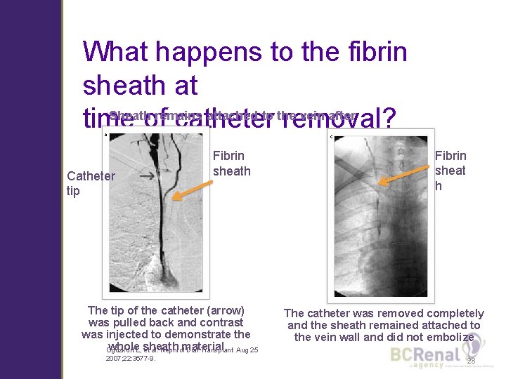What happens to the fibrin sheath at Sheath remains attached to the vein after