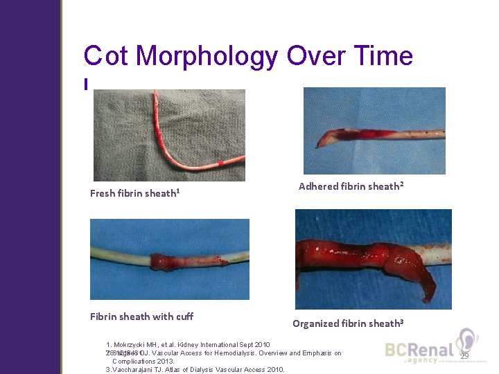 C ot Morphology Over Time l Fresh fibrin sheath 1 Fibrin sheath with cuff
