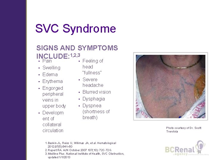 SVC Syndrome SIGNS AND SYMPTOMS INCLUDE: 1, 2, 3 • • • Pain Swelling