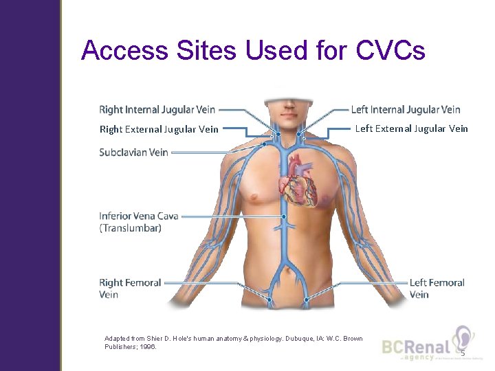 Access Sites Used for CVCs Right External Jugular Vein Left External Jugular Vein Adapted