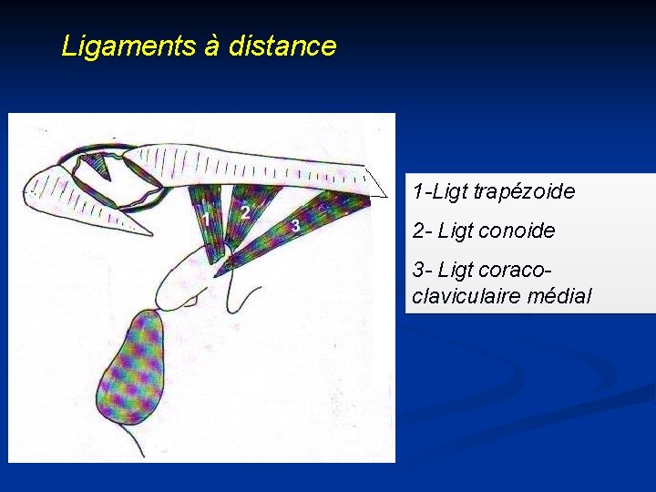 Ligaments à distance 1 -Ligt trapézoide 2 - Ligt conoide 3 - Ligt coracoclaviculaire