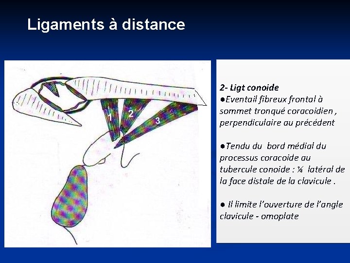 Ligaments à distance 2 - Ligt conoide ●Eventail fibreux frontal à sommet tronqué coracoidien