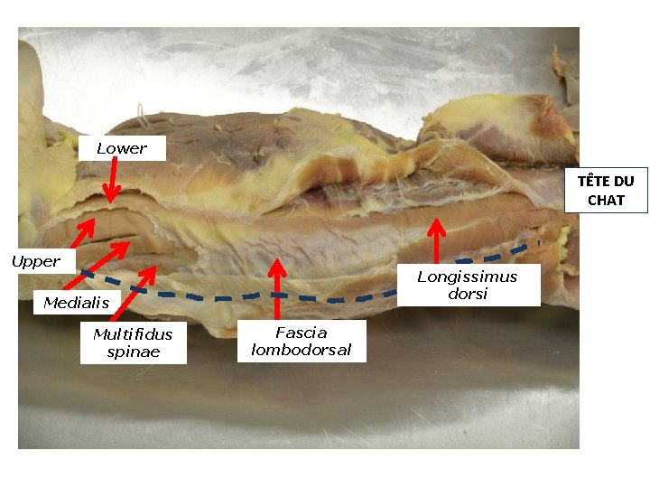 Lower TÊTE DU CHAT Upper Longissimus dorsi Medialis Multifidus spinae Fascia lombodorsal 