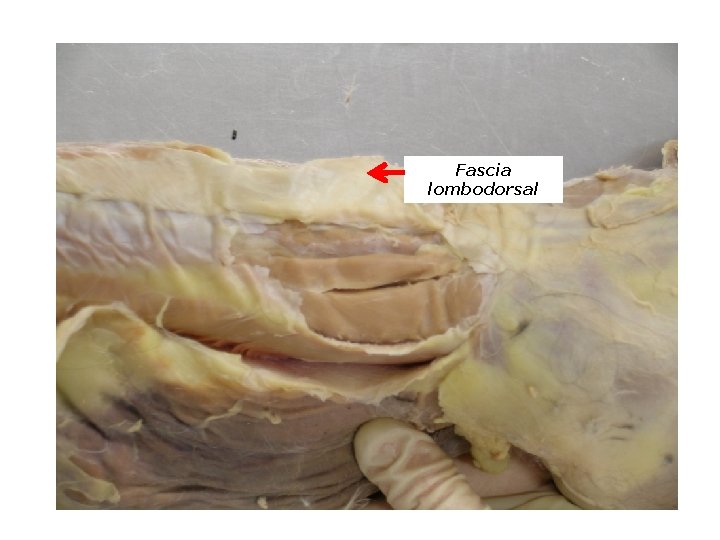 Fascia lombodorsal 