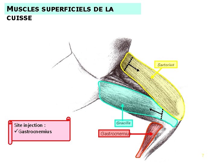 MUSCLES SUPERFICIELS DE LA CUISSE Site injection : üGastrocnemius - Dissection des muscles -