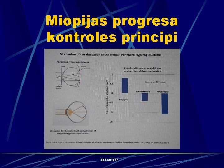 Miopijas progresa kontroles principi ECLSO 2017 