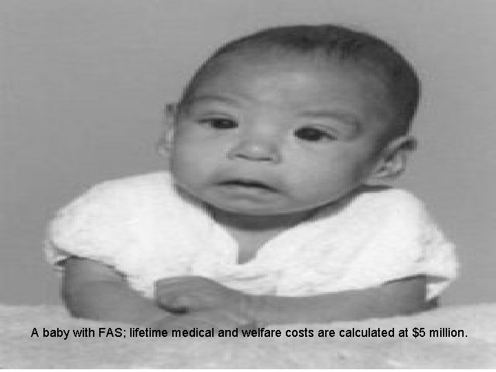 A baby with FAS; lifetime medical and welfare costs are calculated at $5 million.