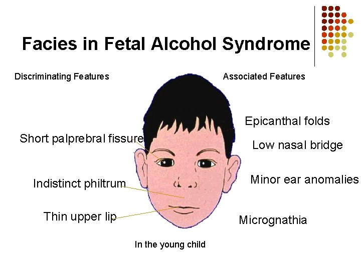 Facies in Fetal Alcohol Syndrome Discriminating Features Associated Features Epicanthal folds Short palprebral fissure