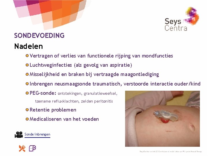 SONDEVOEDING Nadelen Vertragen of verlies van functionele rijping van mondfuncties Luchtweginfecties (als gevolg van