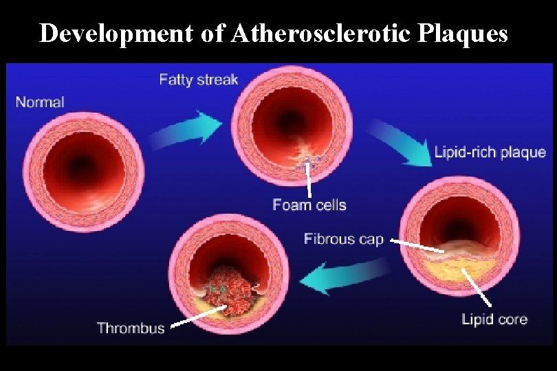 Development of Atherosclerotic Plaques 