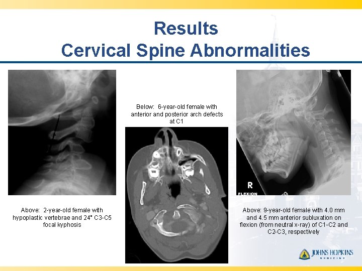 Results Cervical Spine Abnormalities Below: 6 -year-old female with anterior and posterior arch defects