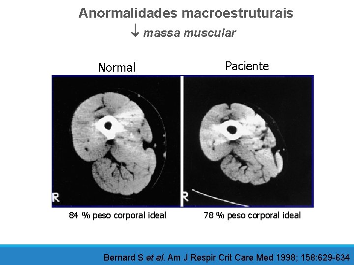 Anormalidades macroestruturais massa muscular Normal 84 % peso corporal ideal Paciente 78 % peso