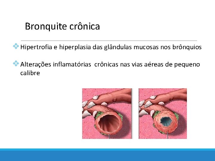 Bronquite crônica v Hipertrofia e hiperplasia das glândulas mucosas nos brônquios v Alterações inflamatórias