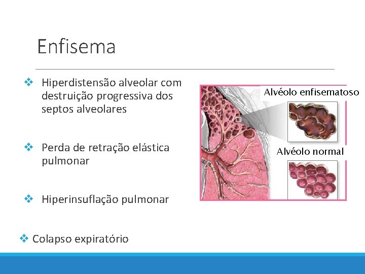 Enfisema v Hiperdistensão alveolar com destruição progressiva dos septos alveolares v Perda de retração