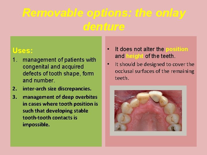Removable options: the onlay denture Uses: 1. management of patients with congenital and acquired