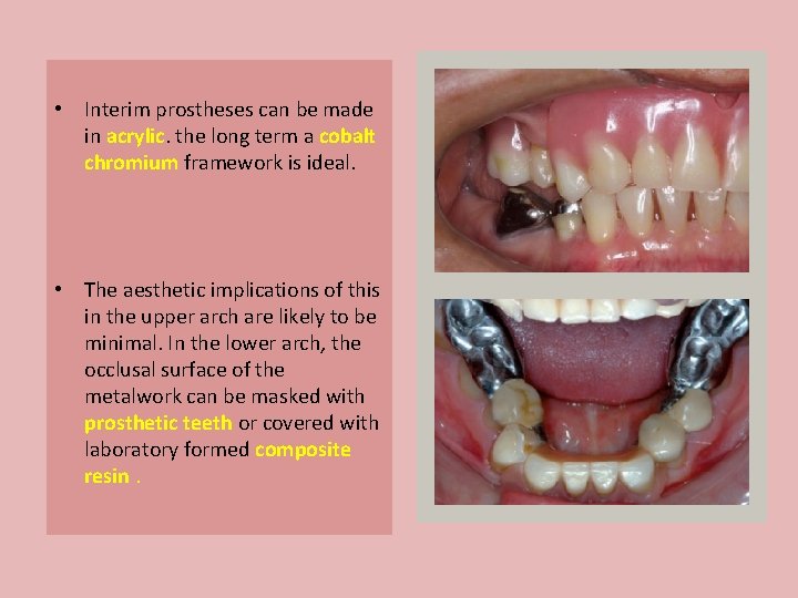  • Interim prostheses can be made in acrylic. the long term a cobalt