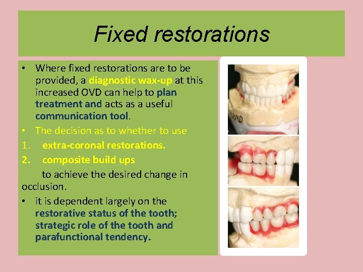 Fixed restorations • Where fixed restorations are to be provided, a diagnostic wax-up at