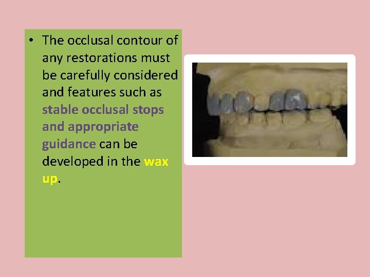  • The occlusal contour of any restorations must be carefully considered and features