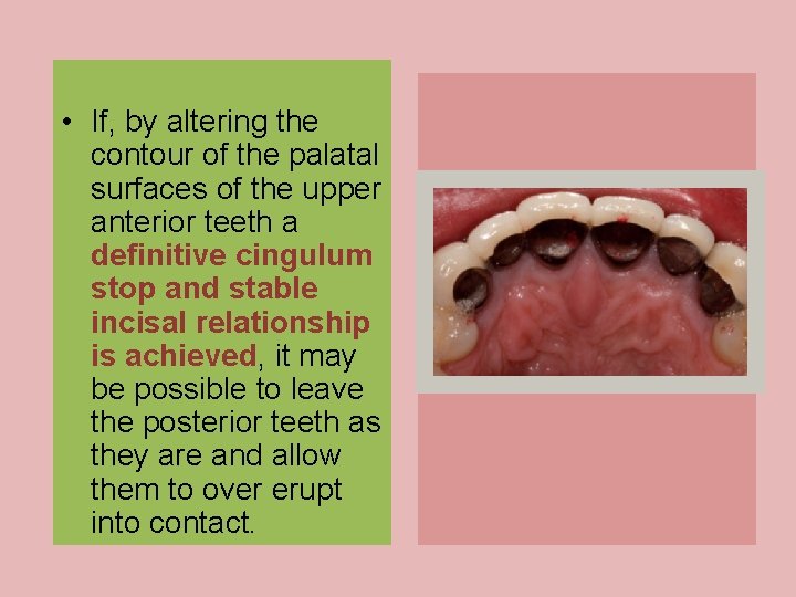  • If, by altering the contour of the palatal surfaces of the upper