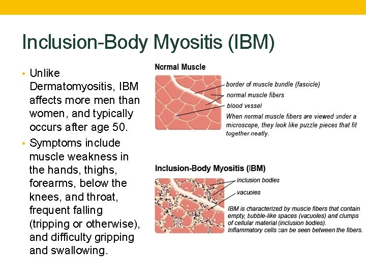 Inclusion-Body Myositis (IBM) • Unlike Dermatomyositis, IBM affects more men than women, and typically