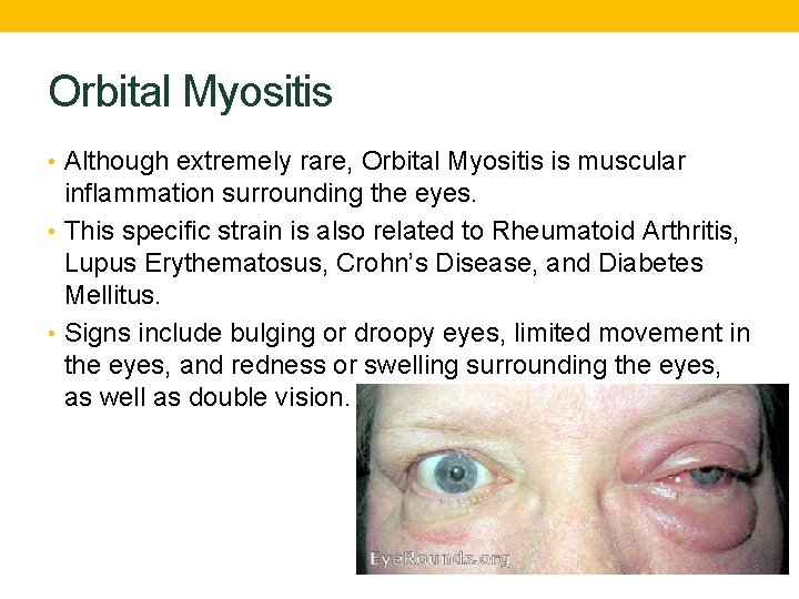 MYOSITIS Isabelle Delgado Per 5 What Is It