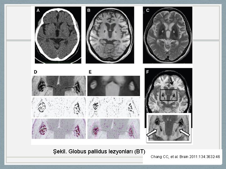 Şekil. Globus pallidus lezyonları (BT) Chang CC, et al. Brain 2011: 134: 3632 -46