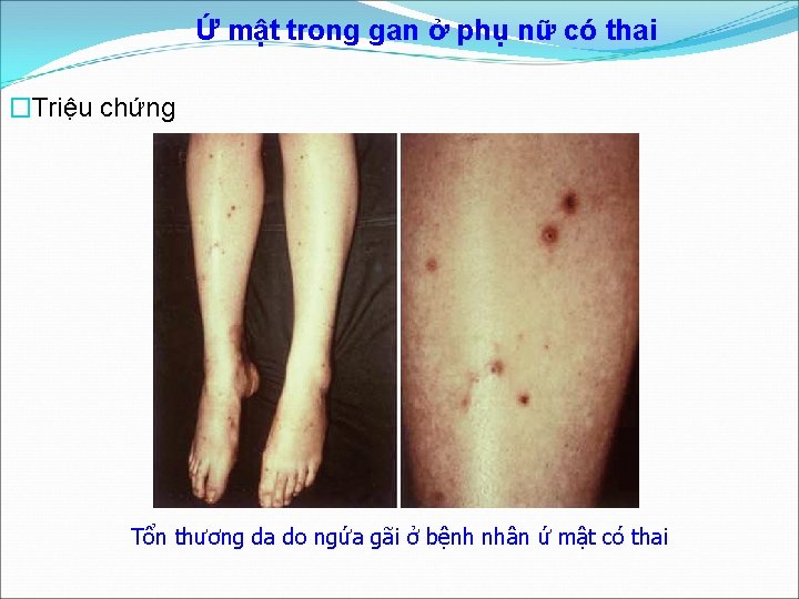 Ứ mật trong gan ở phụ nữ có thai �Triệu chứng Tổn thương da