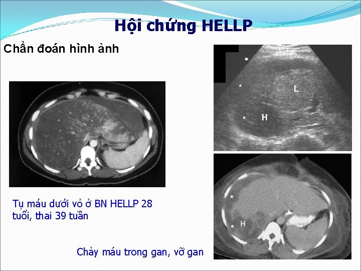 Hội chứng HELLP Chẩn đoán hình ảnh Tụ máu dưới vỏ ở BN HELLP