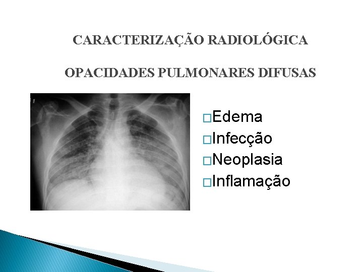CARACTERIZAÇÃO RADIOLÓGICA OPACIDADES PULMONARES DIFUSAS �Edema �Infecção �Neoplasia �Inflamação 