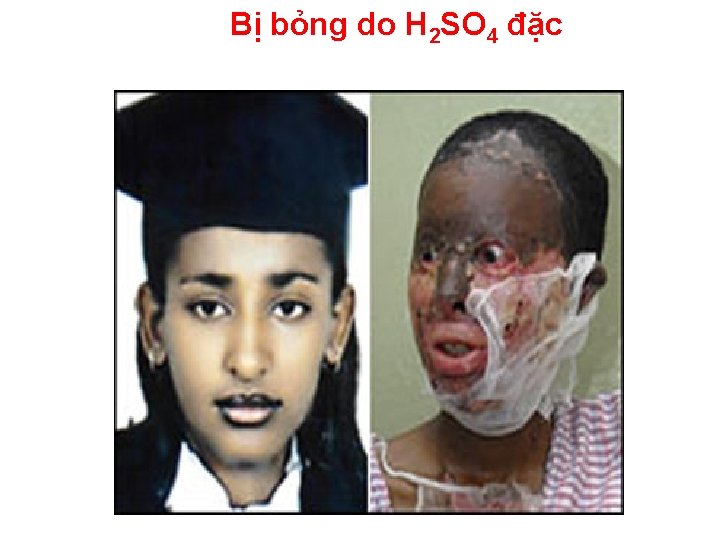 Bị bỏng do H 2 SO 4 đặc 