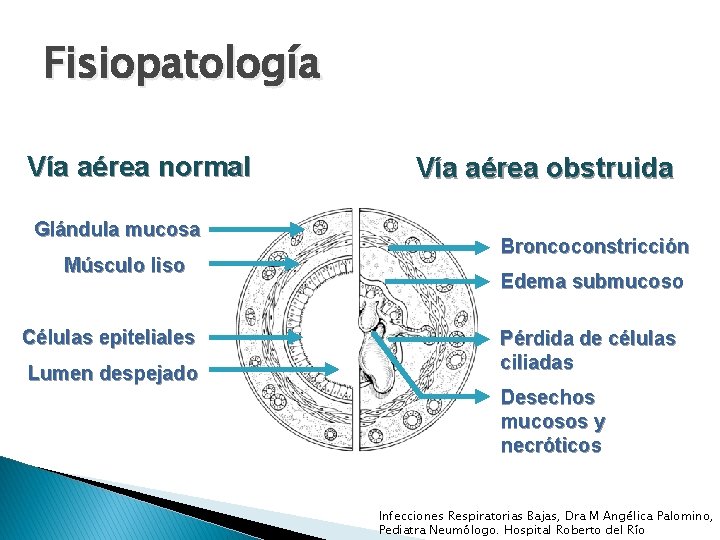 Fisiopatología Vía aérea normal Glándula mucosa Músculo liso Células epiteliales Lumen despejado Vía aérea