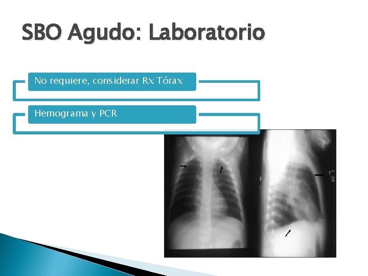 SBO Agudo: Laboratorio No requiere, considerar Rx Tórax Hemograma y PCR 