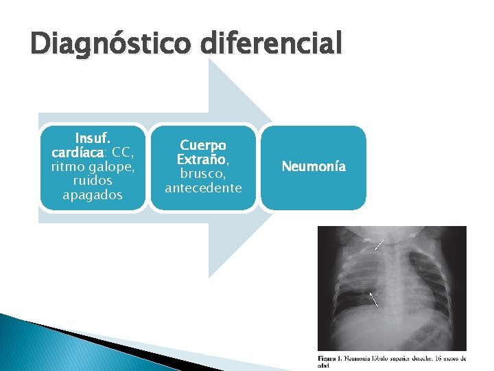 Diagnóstico diferencial Insuf. cardíaca: CC, ritmo galope, ruidos apagados Cuerpo Extraño, brusco, antecedente Neumonía