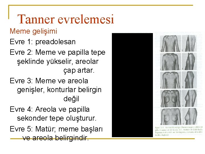 Tanner evrelemesi Meme gelişimi Evre 1: preadolesan Evre 2: Meme ve papilla tepe şeklinde