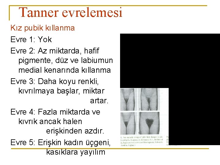 Tanner evrelemesi Kız pubik kıllanma Evre 1: Yok Evre 2: Az miktarda, hafif pigmente,